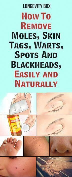 How to remove a flat mole on face and body yourself at home that works. Pin on Warts On Hands