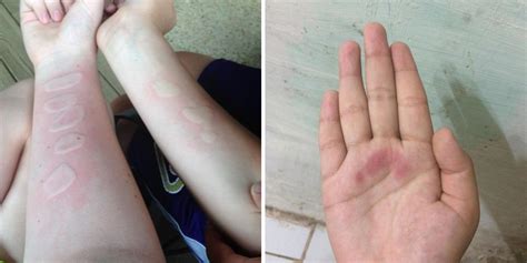 Frostbite that penetrates the deeper layers of the skin and damages tissue and bone can. Salt and Ice Challenge Returns on Social Media - Dangerous ...