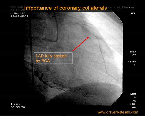 Marketing collateral, in marketing and sales. Can coronary collaterals provide more blood flow than a ...