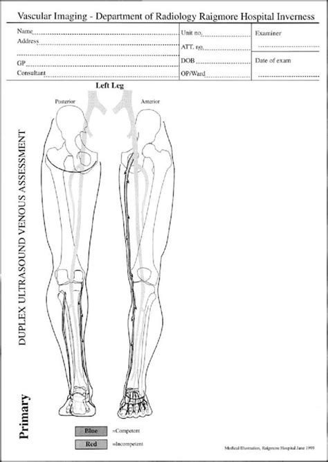 Diagram of groin area / groin muscles diagram koibana info. Whole-leg duplex mapping for varicose veins: Observations on patterns of reflux in recurrent and ...