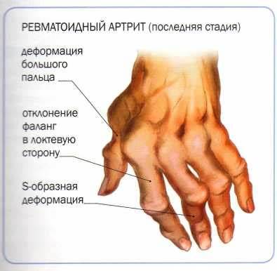 Ревматоидный артрит и диета отзывы Ревматоидный артрит | Meddoc Ревматоидный артрит | Meddoc Ревматоидный артрит и диета отзывы