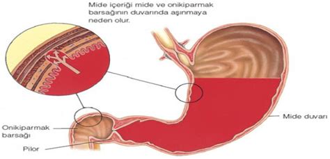 The most common symptoms of a duodenal ulcer are waking at night with upper abdominal pain and upper abdominal pain that improves with. Peptik Ülser Nedir? Tedavi Yöntemleri Nelerdir?