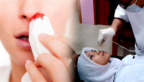 Hidung tersumbat sering dikaitkan dengan pilek atau flu. Hidung sumbat, berdarah petanda kanser | Free Malaysia Today