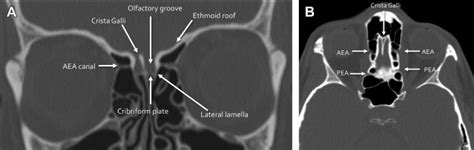 To know what is what, first you should remember their anatomical location in order to know where to expect them; Ethmoid Roof Anatomy & Figure 6. CBCT Coronal View ...