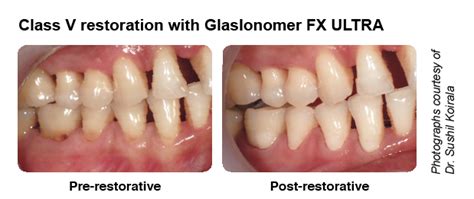 They are ideal for protecting smaller and larger items that. GlasIonomer FX Ultra | Premiere Dental Sdn Bhd | Malaysia