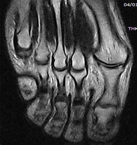 Comparison mri of the brain axial and coronal plane for detect a variety of conditions of the brain such as cysts, tumors, bleeding, swelling, developmental and structural abnormalities, infections. Morton\'s neuroma on a 0,31 T dedicated MRI scanner: a ...