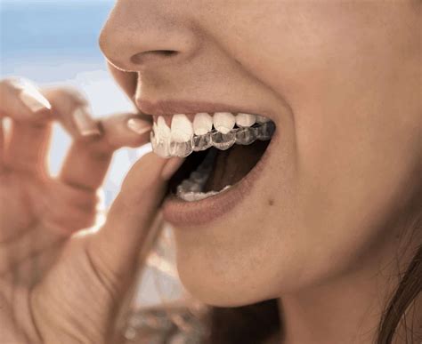 How long does it take to straighten teeth. Clear Braces | Claydon Dental | Cheltenham | Buckinghamshire