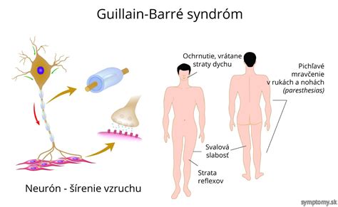 Hughes r.a., hadden r., gregson n., smith k. Guillain - Barrého syndróm - príznaky a liečba