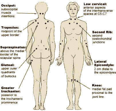 La fibromyalgie n'est pas mortelle car les organes vitaux ne sont pas en jeu mais les douleurs peuvent entraver l'activité physique jusqu'à rendre. Fibromyalgia Tender Points | Fibromyalgia, Arthritis ...