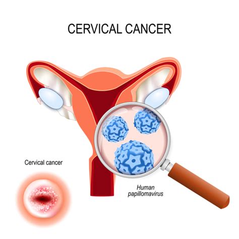 Cancer is caused by malignant (cancerous) cells that grow and multiply without control. Understanding cervical cancer with Dr. Rajas B Patel ...