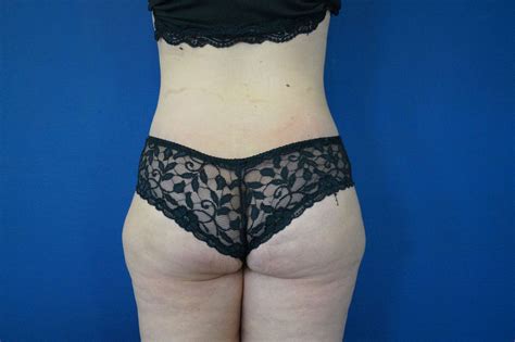 Abdominoplastie, objectifs de l'intervention : Photo avant-apres abdominoplastie, lifting du ventre