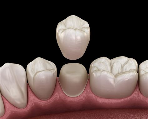 It might be a huge cavity, or a which type is best for you will be determined in part by your occlusion (how your teeth fulfill) and before placing a crown, if not much of the tooth is remaining, your dental practitioner might have to. When Is A Dental Crown Needed in DuPont | Dupont Family ...