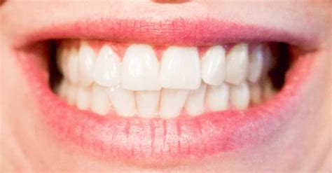 Coffee contains tannin that colors teeth with its compounds. Does Coffee Stain Your Teeth? How to Remove & Prevent?