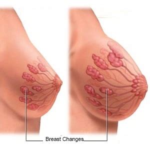 What does hpv look like? Cambios en los senos en el embarazo temprano | SaludAIO