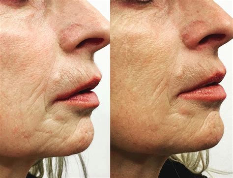 We did not find results for: Shedding Microneedling : Microneedling Update - Shedding ...