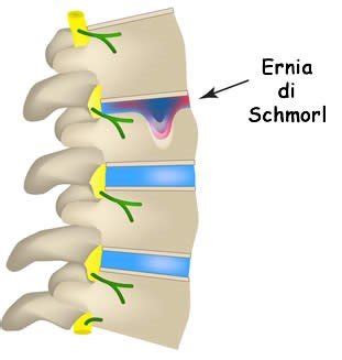 Le ernie del disco verticali o di Schmorl | MEDICITALIA.it