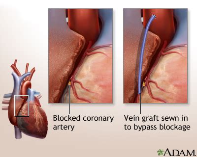 Click here to read the full article. Heart bypass surgery | Multimedia Encyclopedia | Health ...