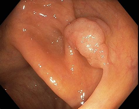 The colon is the last part of the digestive system.it has a segmented appearance due to a series of saccules called haustra. What is a colon polyp? | BowelPrepGuide