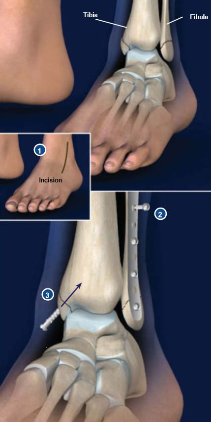 Tibia and fibula fractures are broken bones of the lower leg. Cirugía de Fractura de Tobillo | Grupo médico ortopédico ...