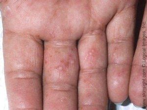 Wear thick socks or work gloves for blisters on the feet or hands. Decoding the mystery of dyshidrotic eczema | National ...