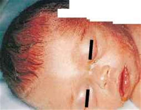 Epicanthic folds is a skin fold on the upper eyelid which covers the inner angle of the eye, which makes them appear smaller and more slanted, even if what are epicanthal folds? Robinow Syndrome Type - Newborns - RR School Of Nursing