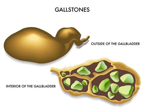 Hempedu atau hempedu adalah hijau gelap kepada cairan coklat kekuningan, yang dihasilkan oleh hati kebanyakan vertebrata, yang membantu pencernaan lipid dalam usus kecil. Diet Selepas Buang Hempedu! | Fit Mummy For Life