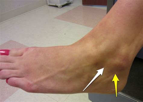 Ligament updated their profile picture. Ankle Instability | Dr. David Geier - Sports Medicine ...