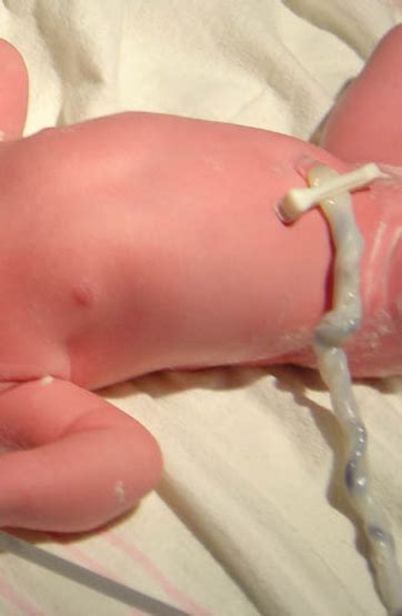 When does the umbilical cord fall off the baby? Umbilical Cord Stem Cells - Current Uses & Future Challenges