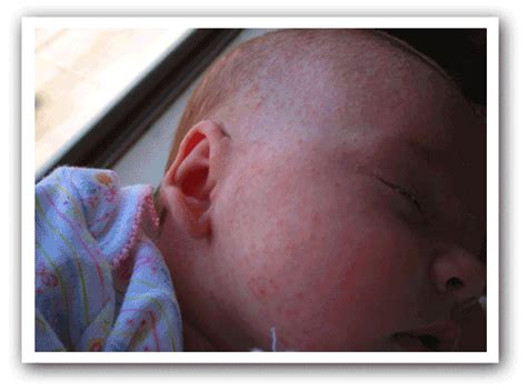 However, not all rashes are listed, so contact your baby's healthcare provider if you. lisovzmesy: heat rash on baby face