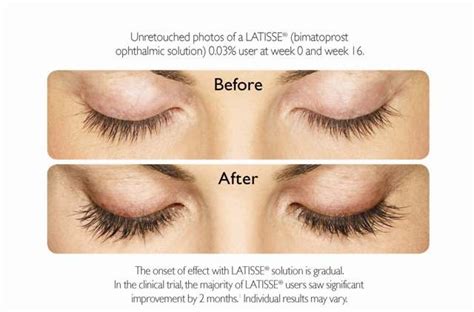 Latisse (bimatoprost) is a topical prostaglandin eye solution. Stunning before/after images of a Latisse user. Try it for ...