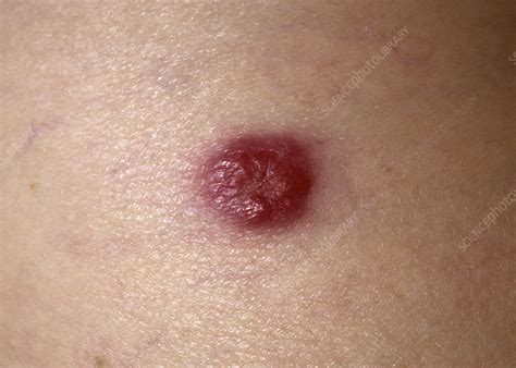 Merkel cell carcinoma (mcc) gets its name because these skin cancer cells resemble merkel cells mcc is one type of skin cancer, and its cells resemble merkel cells. Merkel Cell : Trends In Merkel Cell Carcinoma Physician S ...