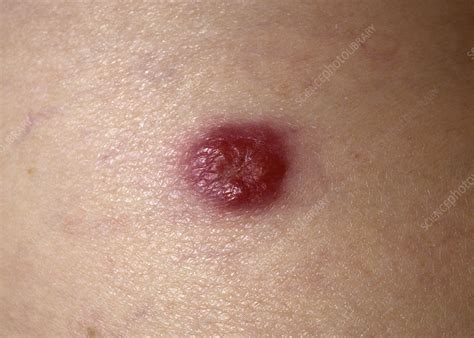 • early detection and treatment are important because. Merkel Cell : Trends In Merkel Cell Carcinoma Physician S ...