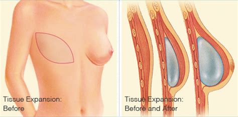 While these seem like 2 separate categories, they can be combined in many cases to help patients achieve their reconstructive goals. Breast Reconstruction After Radiation Therapy - All About ...