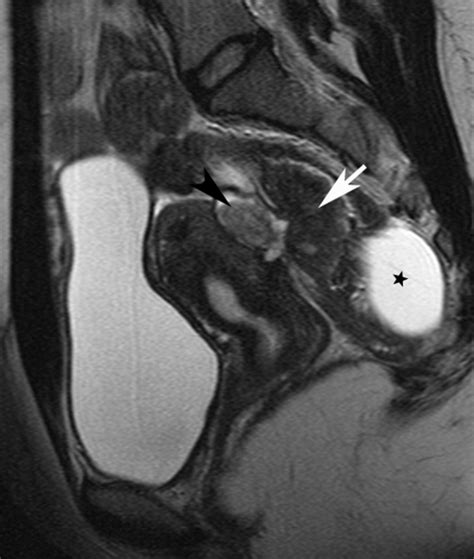 Endometriosis is the abnormal growth of endometrial cells outside the uterus. Rectosigmoid colon endometriosis: sagittal T2-weighted MRI ...