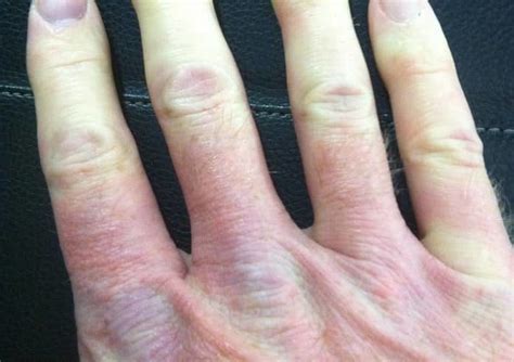 Terence renaud received his ph.d. Managing Raynaud Phenomenon - Medical News Bulletin ...