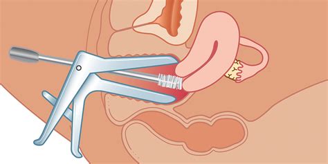 The papanicolaou test (abbreviated as pap test, also known as pap smear (ae), cervical smear (be), cervical screening (be), or smear test (be)) is a method of cervical screening used to detect potentially precancerous and cancerous processes in the cervix (opening of the uterus or womb) or colon. What an Abnormal Pap Smear Really Means—and What Comes ...