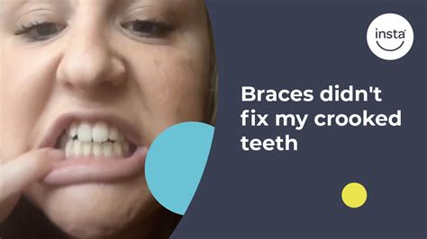 Maybe you would like to learn more about one of these? Braces didn't fix my crooked teeth so instasmile ...