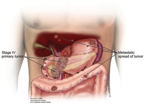 Often, the goal of treating metastatic cancer is to control it by stopping or slowing its growth. Stage IV Pancreatic Cancer - Pancreatic Cancer Action Network/