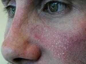 Dermatite Seborroica (DS): colpisce spesso il volto ...