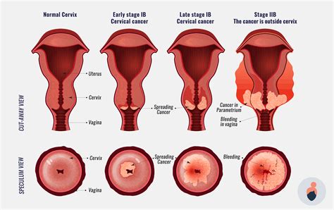 Hpv is now associated with 9,000 if you have any of these symptoms, let your dentist know, especially if you've had them for two weeks or more. What Is HPV and How Do You Know if You Have It? | Elara Care