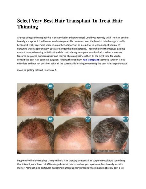 Select very best hair transplant to treat hair thinning ...