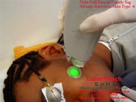 The laser inhibits the hair's. Male / African American Full Face Laser Hair Removal ...