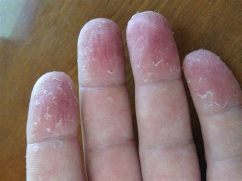 This can be very painful and lead to complications if not properly. How to get rid of peeling skin on hands > ALQURUMRESORT.COM