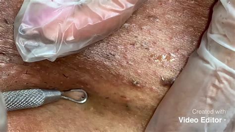 The skin then identifies the hair as a foreign body. Extractions ( black head / ingrown hair removal ) - YouTube