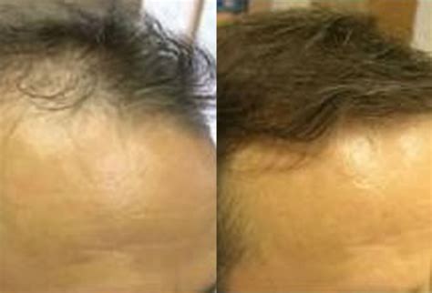 But it won't get me. Before And After, 50 year old man, 3000 grafts - Toronto ...