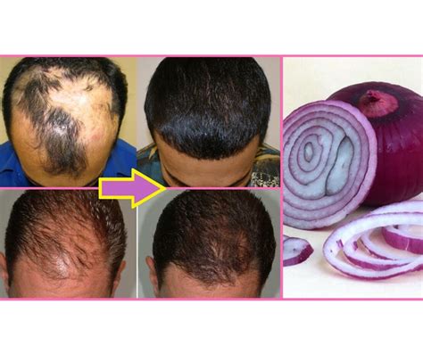 Complaint no more because you actually can. HOMEMADE ONION HAIR MASK FOR HAIR REGROWTH - V Beautify