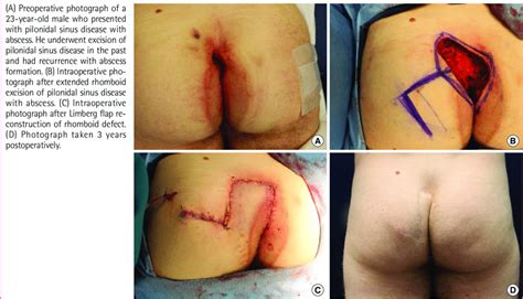 Signs and symptoms of an infected pilonidal cyst include: Patient with pilonidal sinus disease with abscess ...