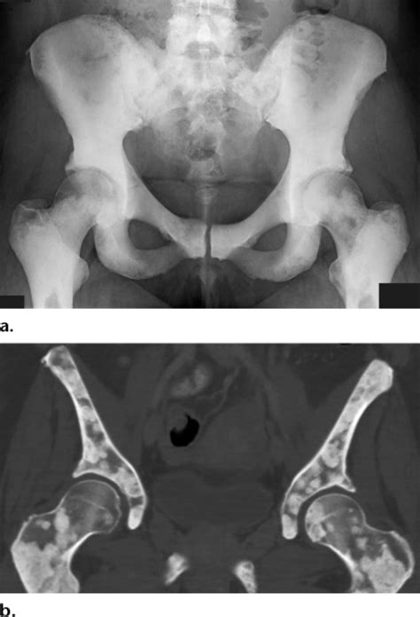 The stage shows how far the cancer has spread. Does A Ct Scan Show Breast Cancer - ct scan machine