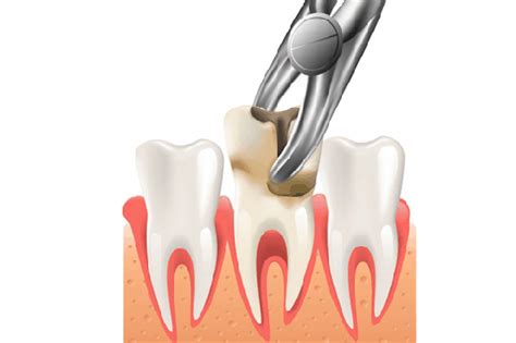 More often than not, tooth removal is required when. HOlistic dentist near me explained about root canal and ...