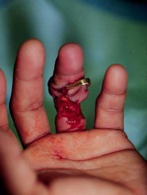 Degloved finger | Medical, Er nurse, Emt paramedic